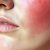 Rumień a trądzik różowaty: jak rozpoznać i kiedy sięgnąć po pomoc dermatologa